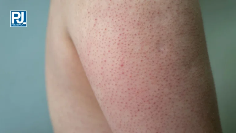 Kerafol: crema cheratolitica per ipercheratosi